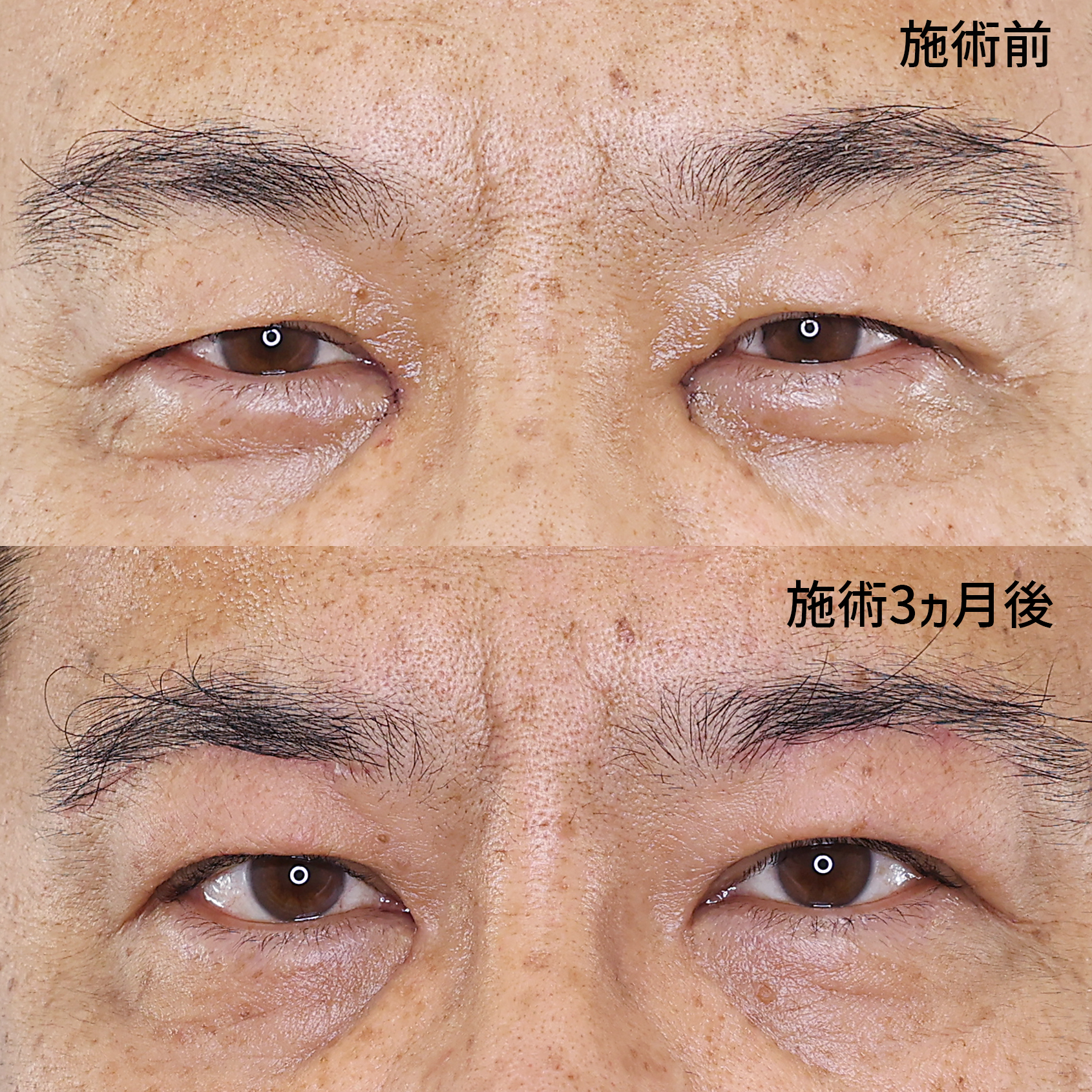 目頭切開術/眉毛下切開術/目尻切開術の症例写真 施術前後 