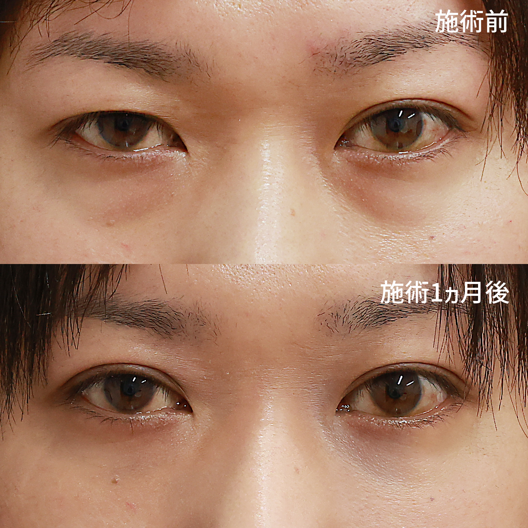 片目二重術（片目だけ整形したい方）/下眼瞼脱脂術（目の下のたるみ取り・目の下の脂肪ふくらみ取り）/顔の脂肪注入(コンデンスリッチフェイス)の症例写真 施術前後 
