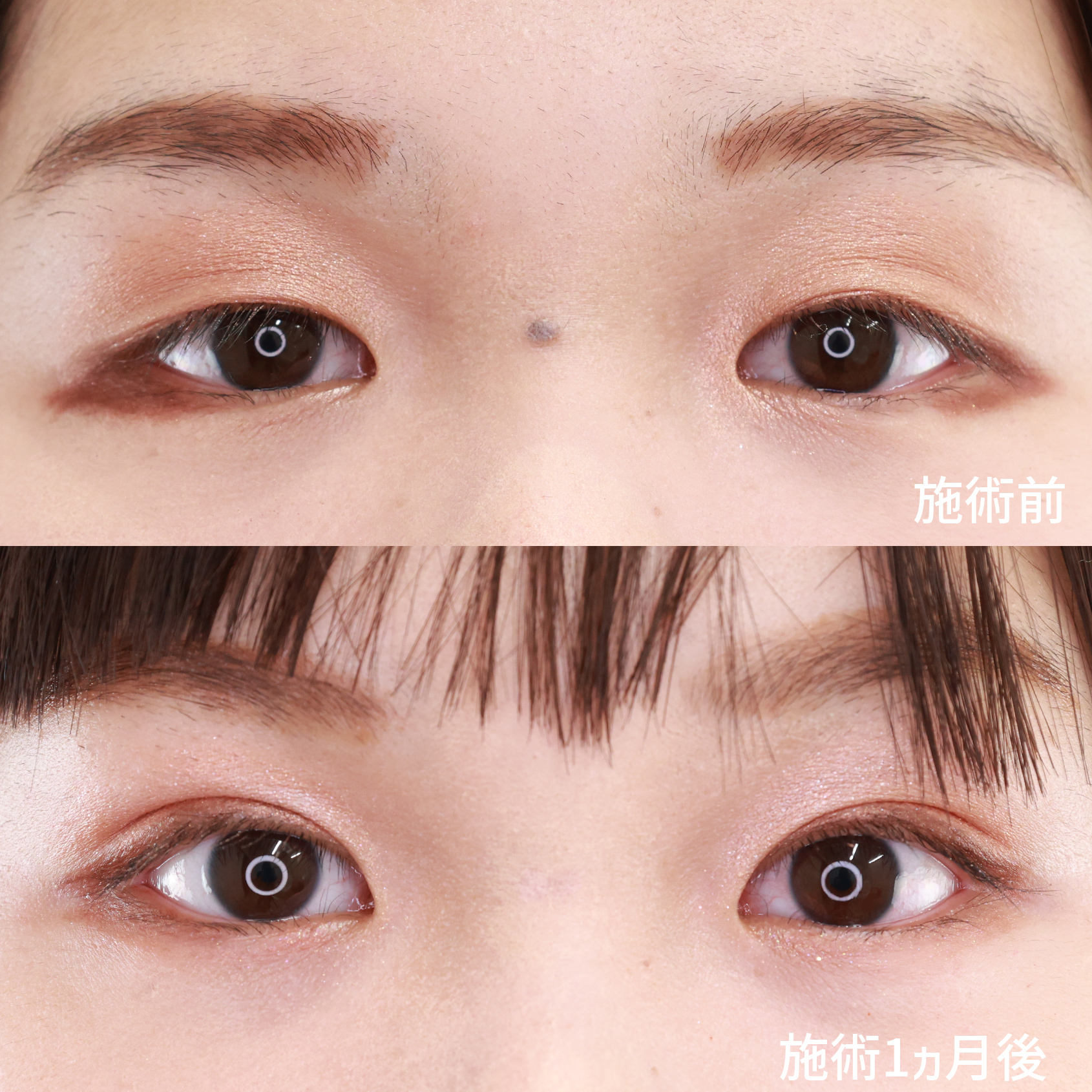 二重埋没法/目元：その他/ホクロ除去の症例写真 施術前後 １ヵ月