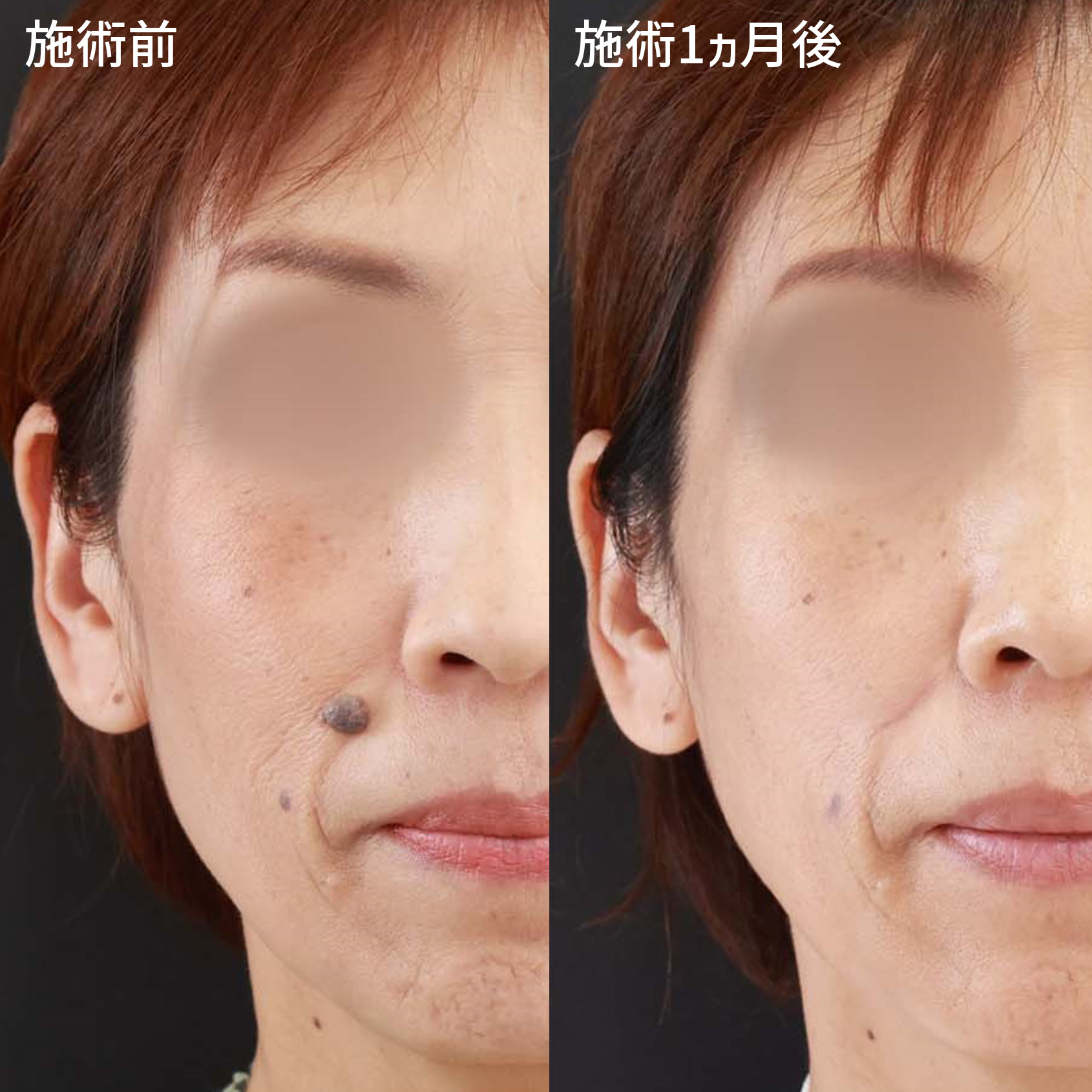 ホクロ除去の症例写真 施術前後 1ヵ月