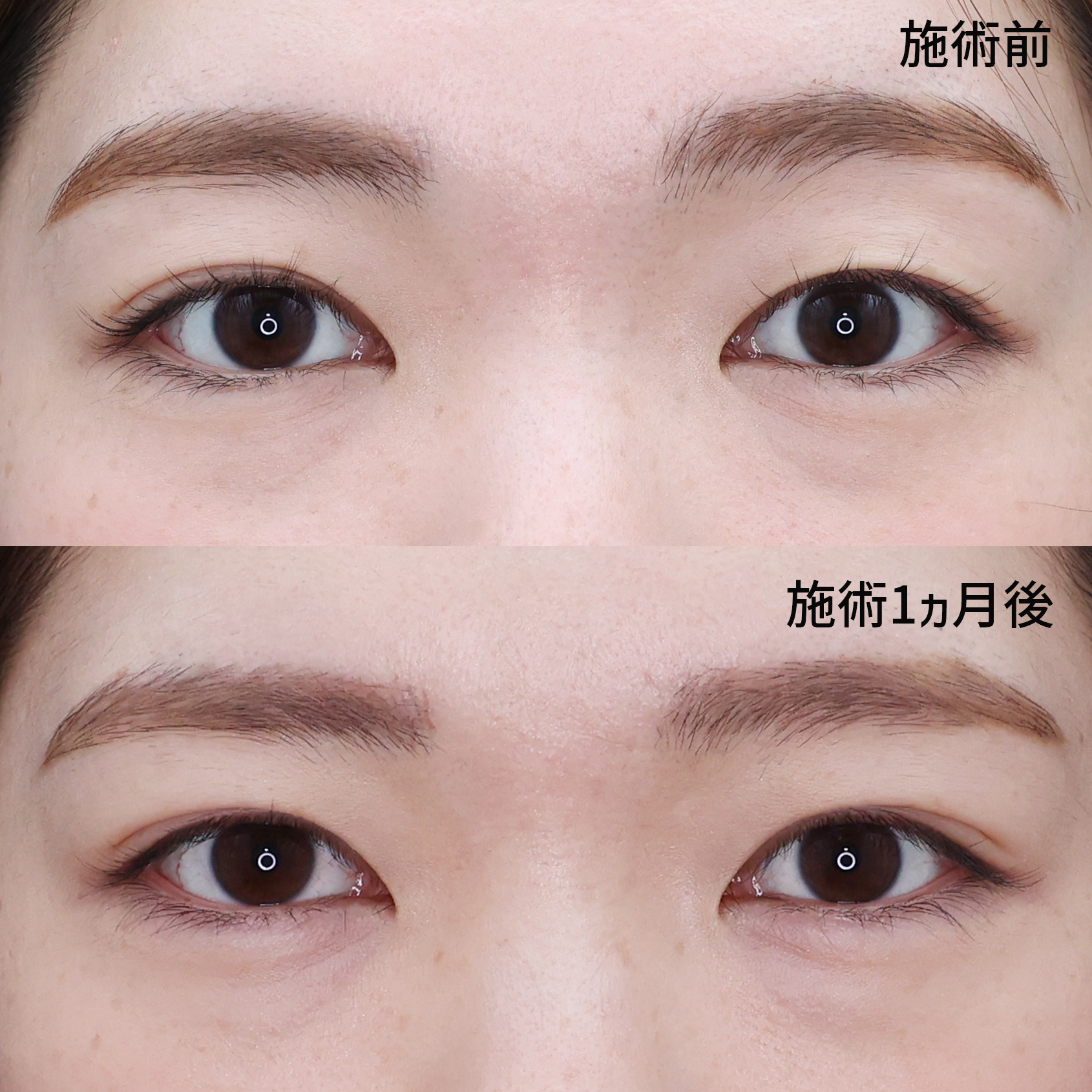 片目二重術（片目だけ整形したい方）/二重埋没法の症例写真 施術前後 