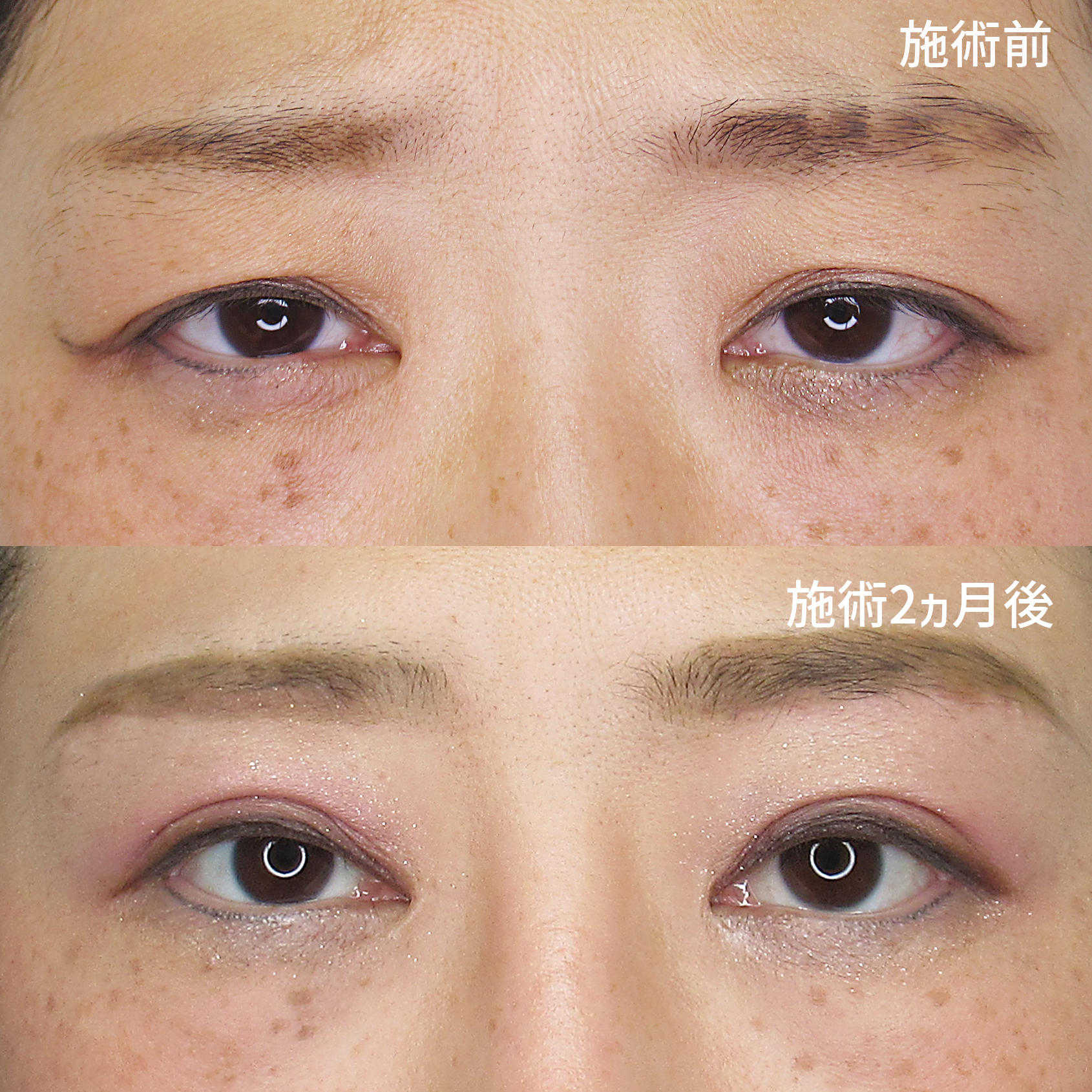 眉毛下切開術/上眼瞼切開術/眼瞼下垂（目つき矯正）の症例写真 施術前後 