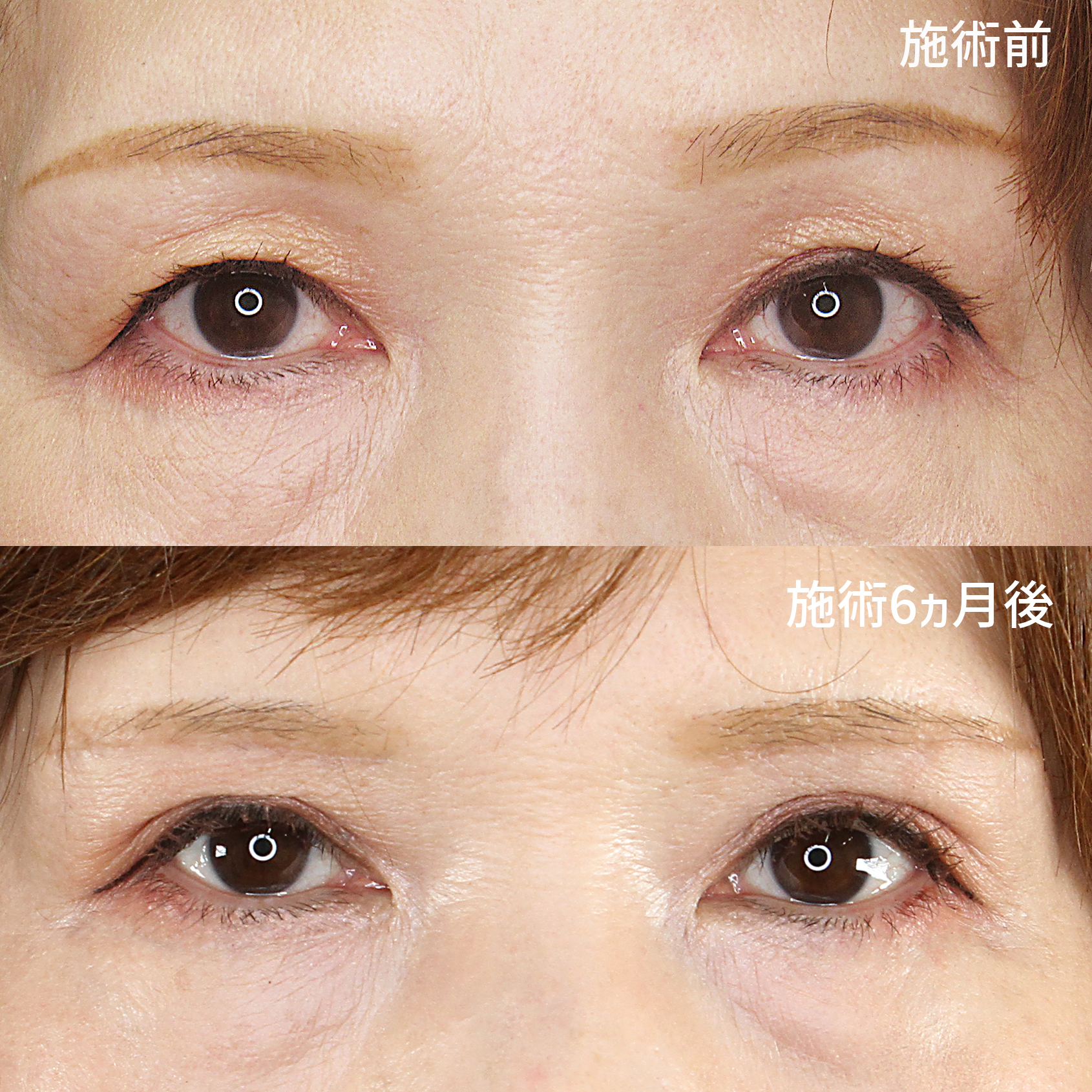 眉毛下切開術/眼瞼下垂（目つき矯正）/上眼瞼切開術の症例写真 施術前後 