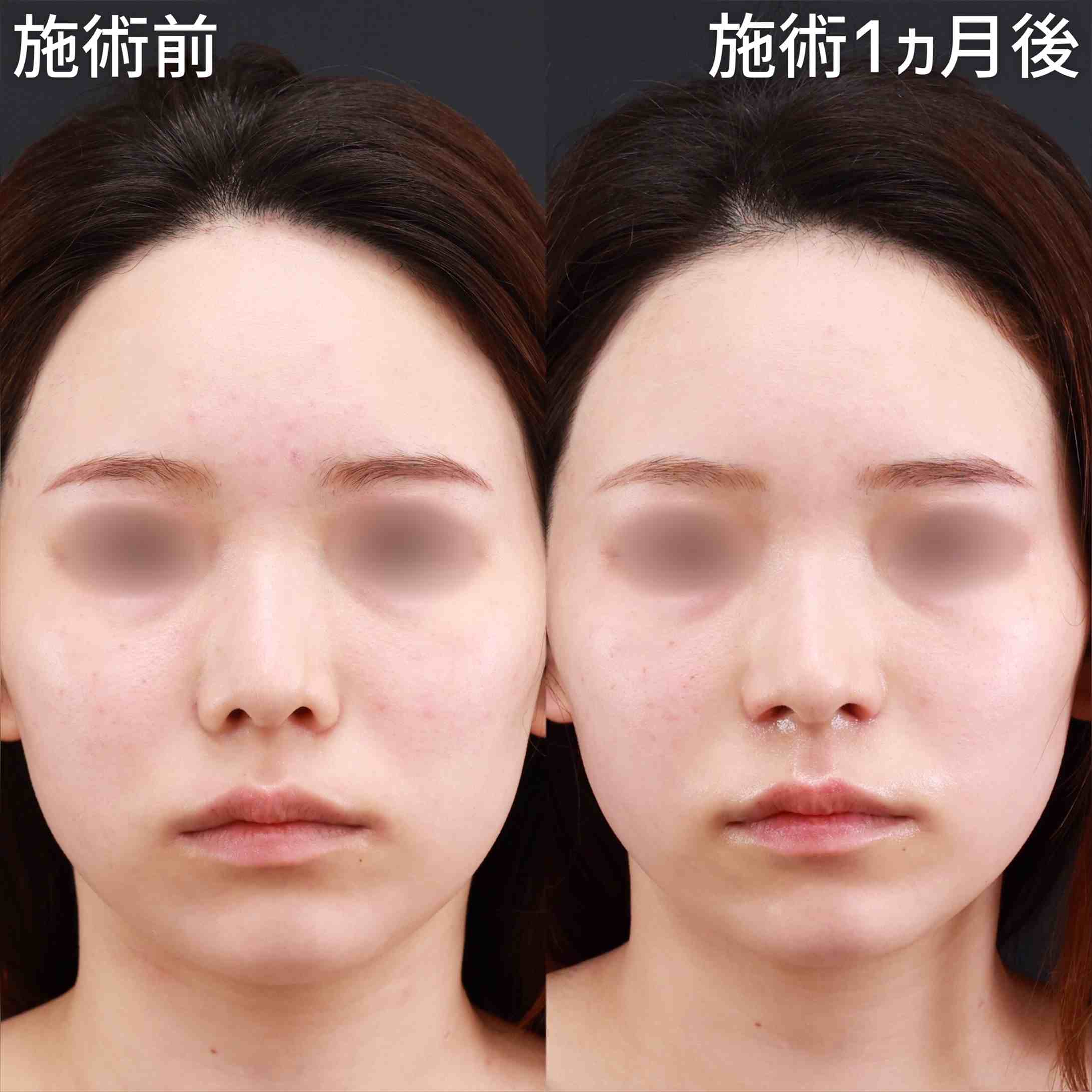 鼻翼挙上術/鼻孔縁挙上術の症例写真 施術前後 