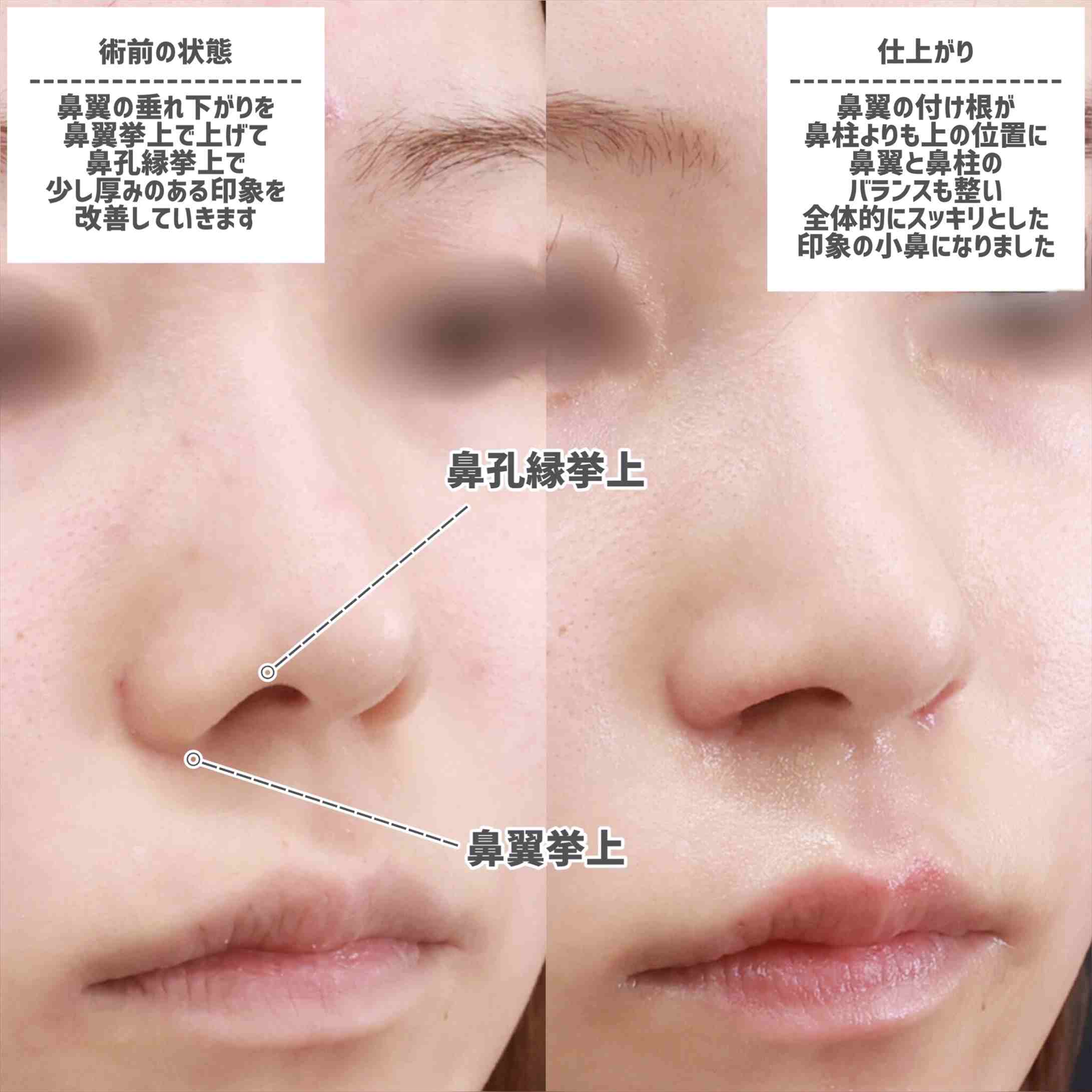 鼻翼挙上術/鼻孔縁挙上術の症例写真 施術前後 