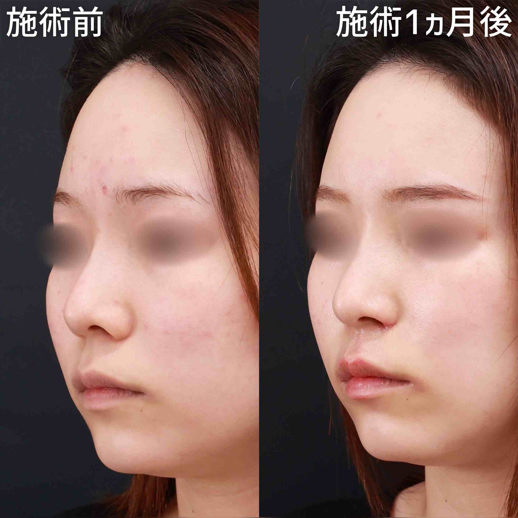 鼻翼挙上術/鼻孔縁挙上術の症例写真 施術前後 