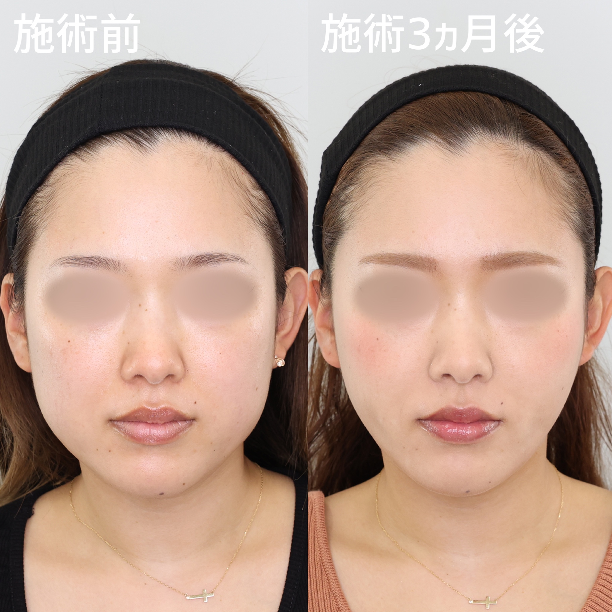 ジョールファット除去/TAC式 ツヤ肌コラーゲンリフト®の症例写真 施術前後 