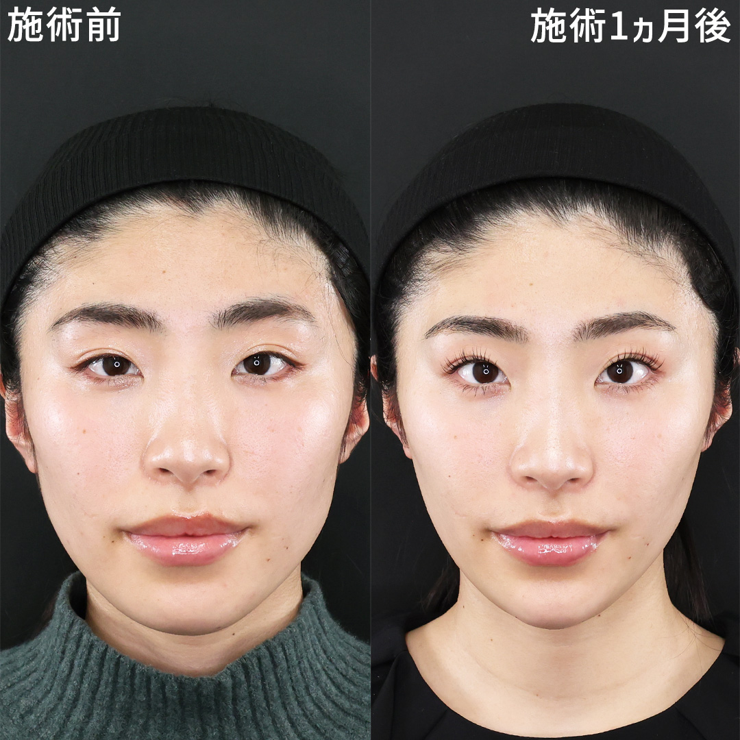 TAC式 ツヤ肌コラーゲンリフト®/TAC式 ショッピングリフト/エラボトックス注射の症例写真 施術前後 