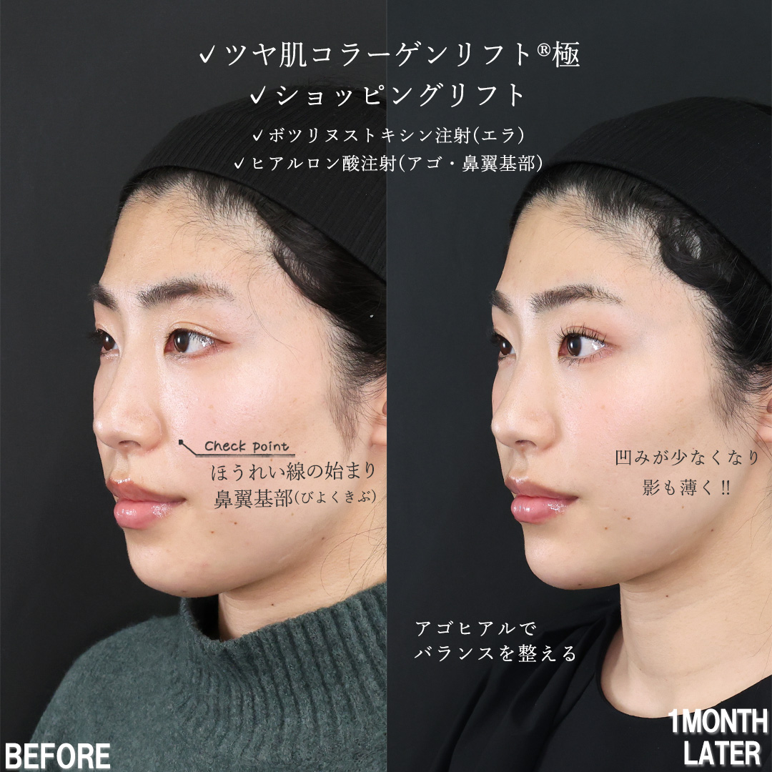 TAC式 ツヤ肌コラーゲンリフト®/TAC式 ショッピングリフト/エラボトックス注射の症例写真 施術前後 