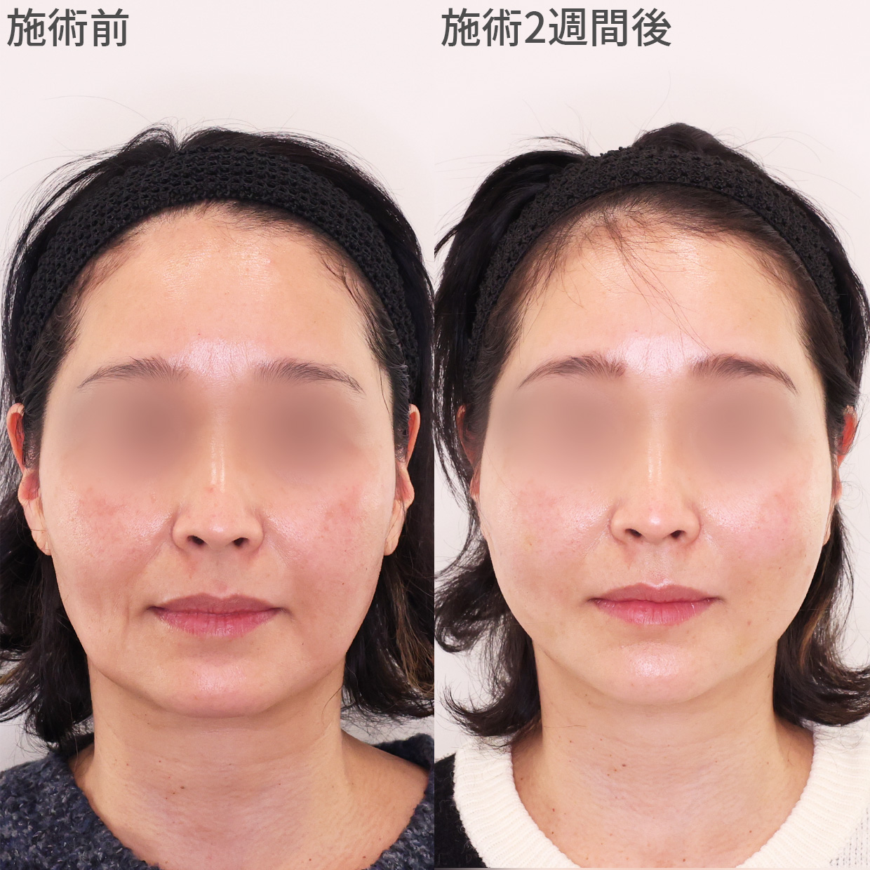 TAC式 ショッピングリフト/TAC式 ツヤ肌コラーゲンリフト®の症例写真 施術前後 