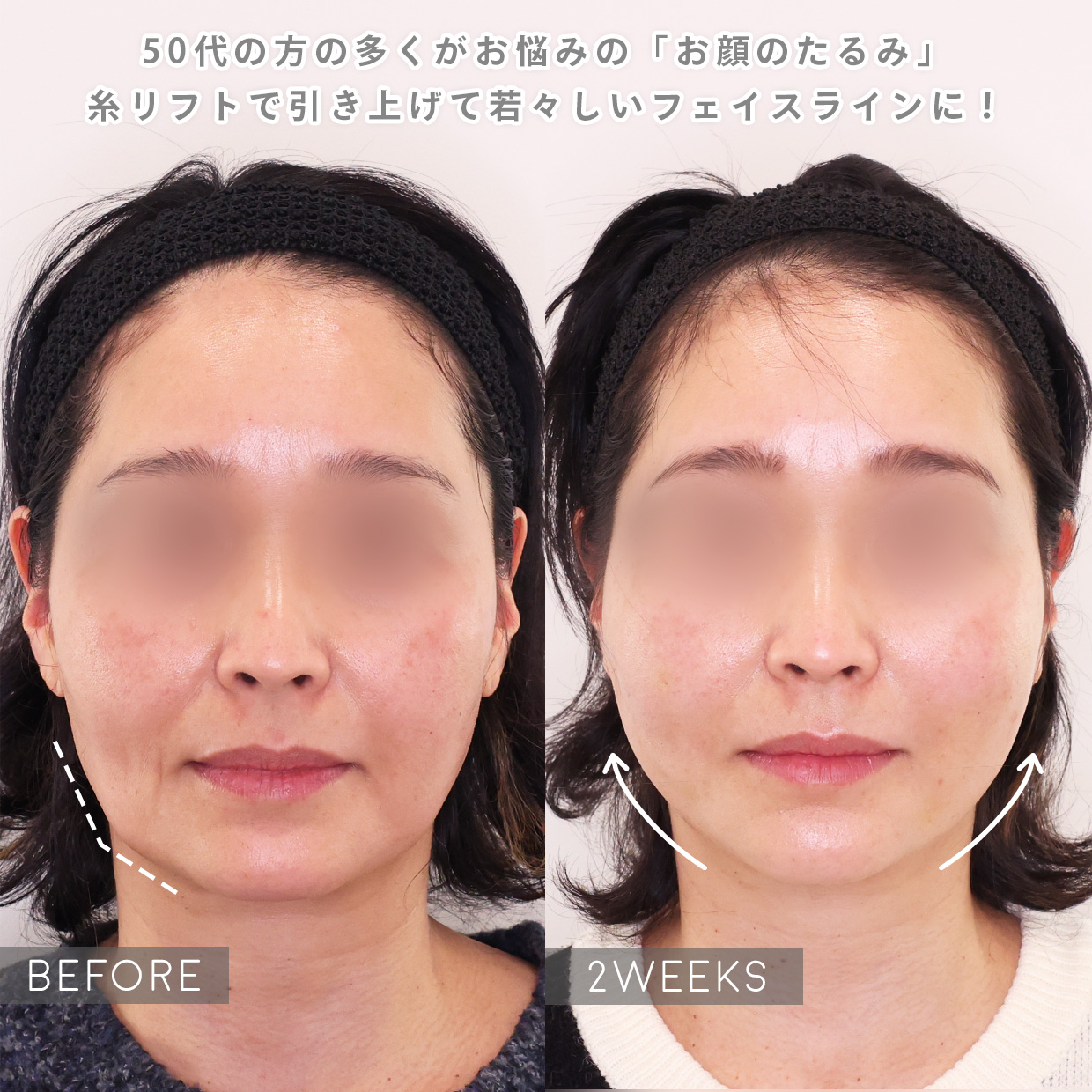 TAC式 ショッピングリフト/TAC式 ツヤ肌コラーゲンリフト®の症例写真 施術前後 