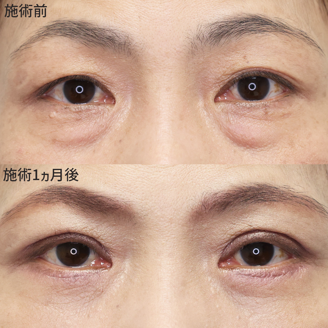 上眼瞼切開術/下眼瞼切開術（クマ・たるみとり）/下眼瞼脱脂術（目の下のたるみ取り・目の下の脂肪ふくらみ取り）の症例写真 施術前後 