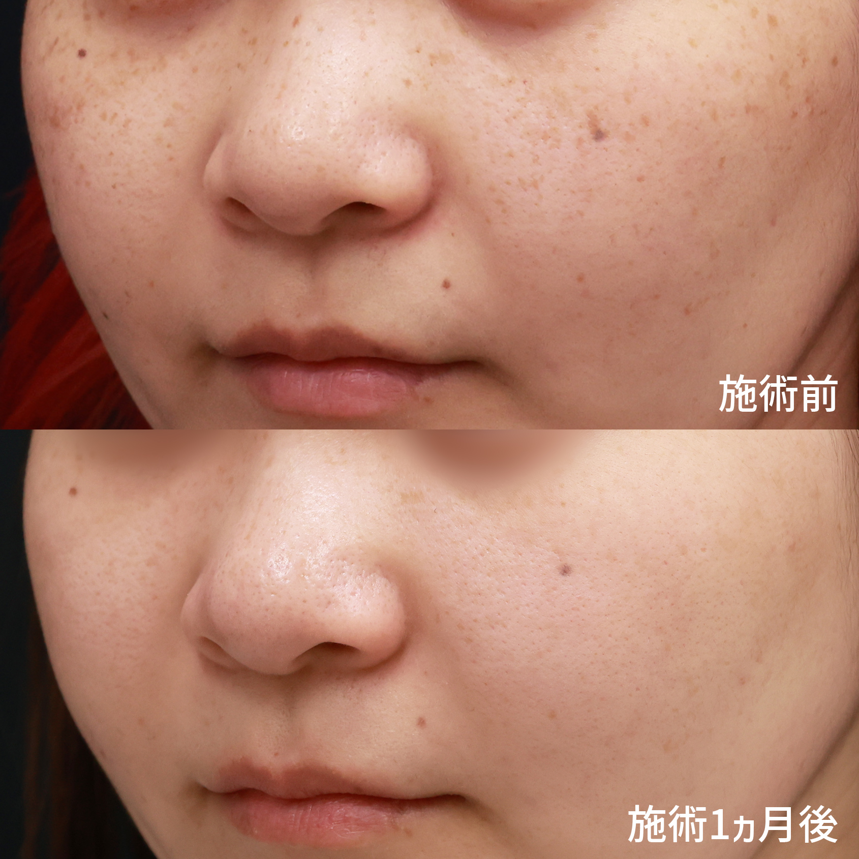 フォトシルクプラス光治療の症例写真 施術前後 