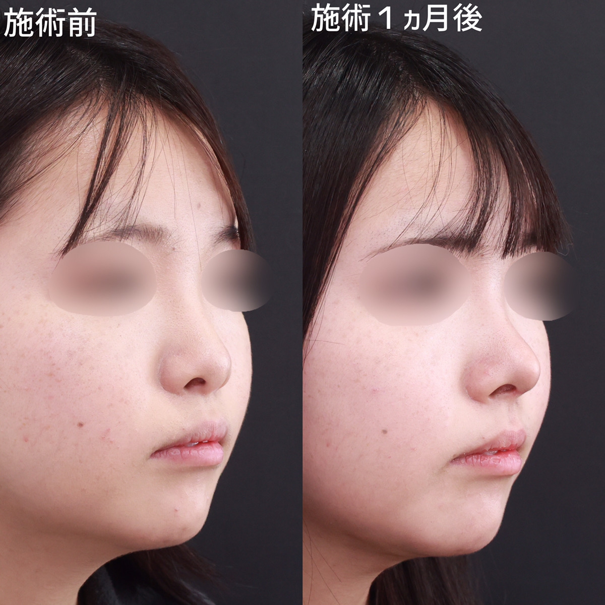 鼻尖形成・鼻尖縮小/鼻先軟骨移植の症例写真 施術前後 