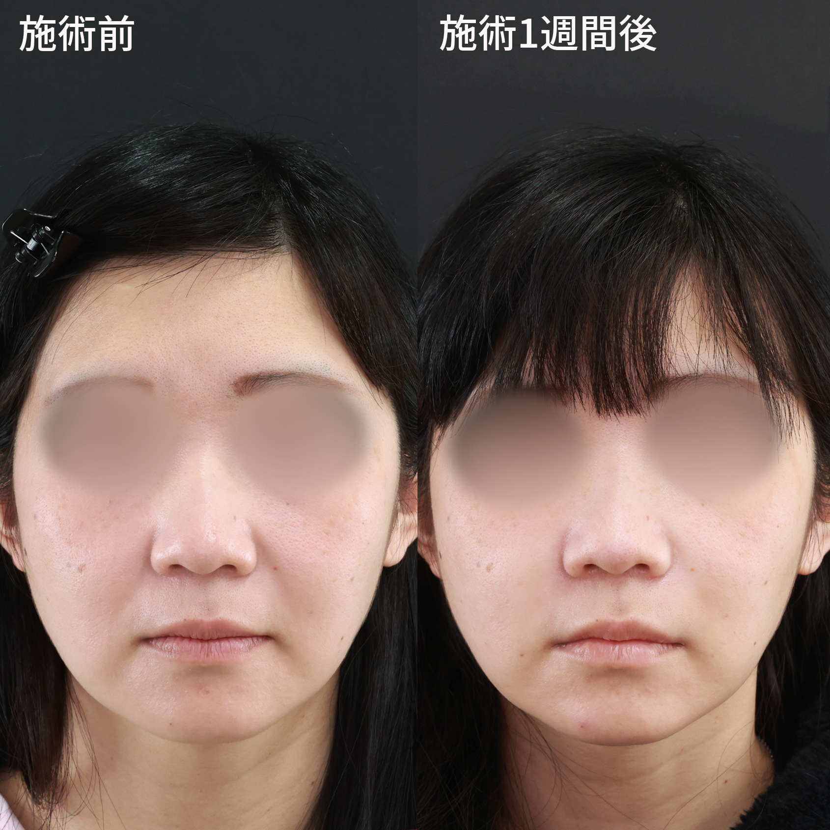 貴族手術（鼻翼基部プロテーゼ・脂肪注入・粉砕肋軟骨移植）の症例写真 施術前後 