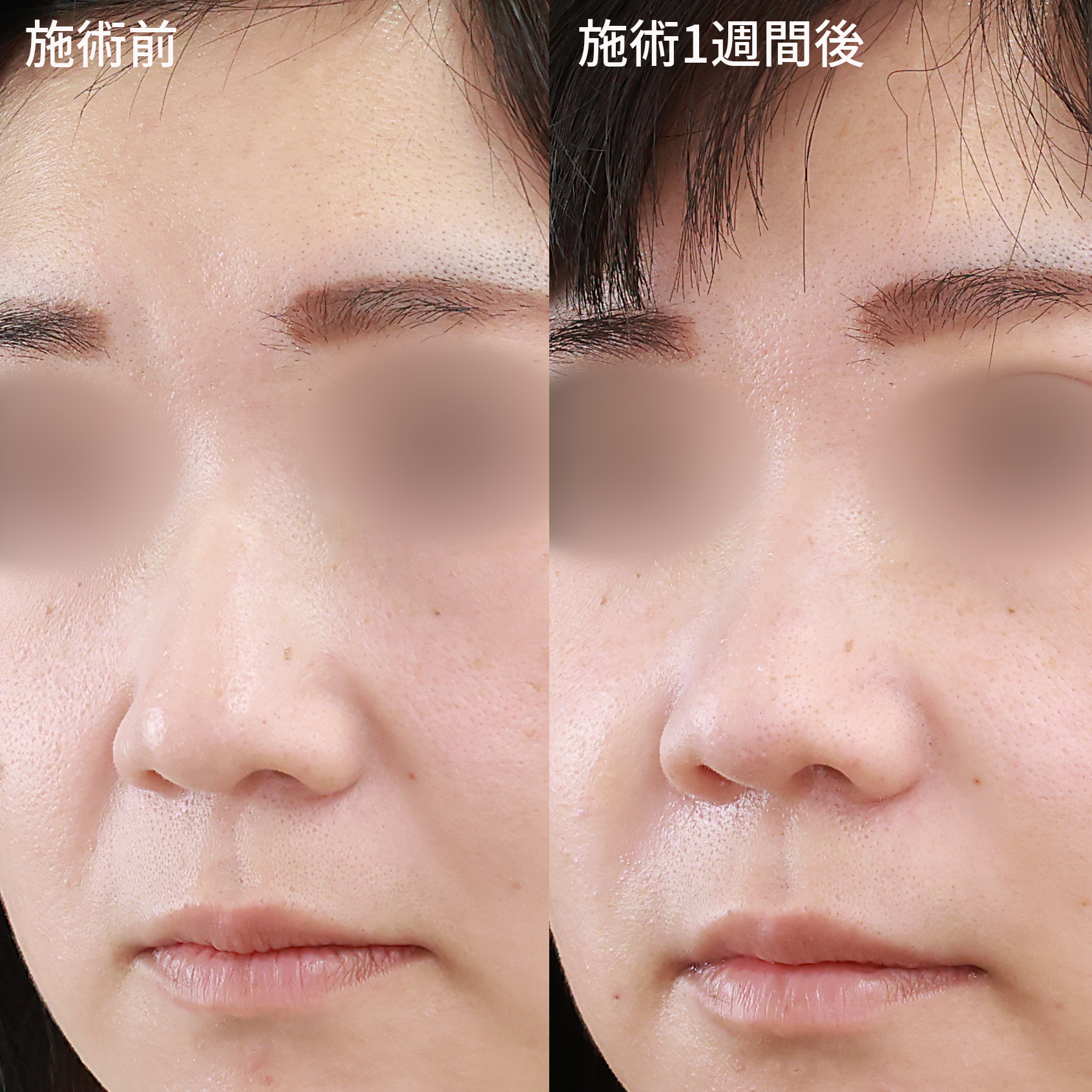 貴族手術（鼻翼基部プロテーゼ・脂肪注入・粉砕肋軟骨移植）の症例写真 施術前後 