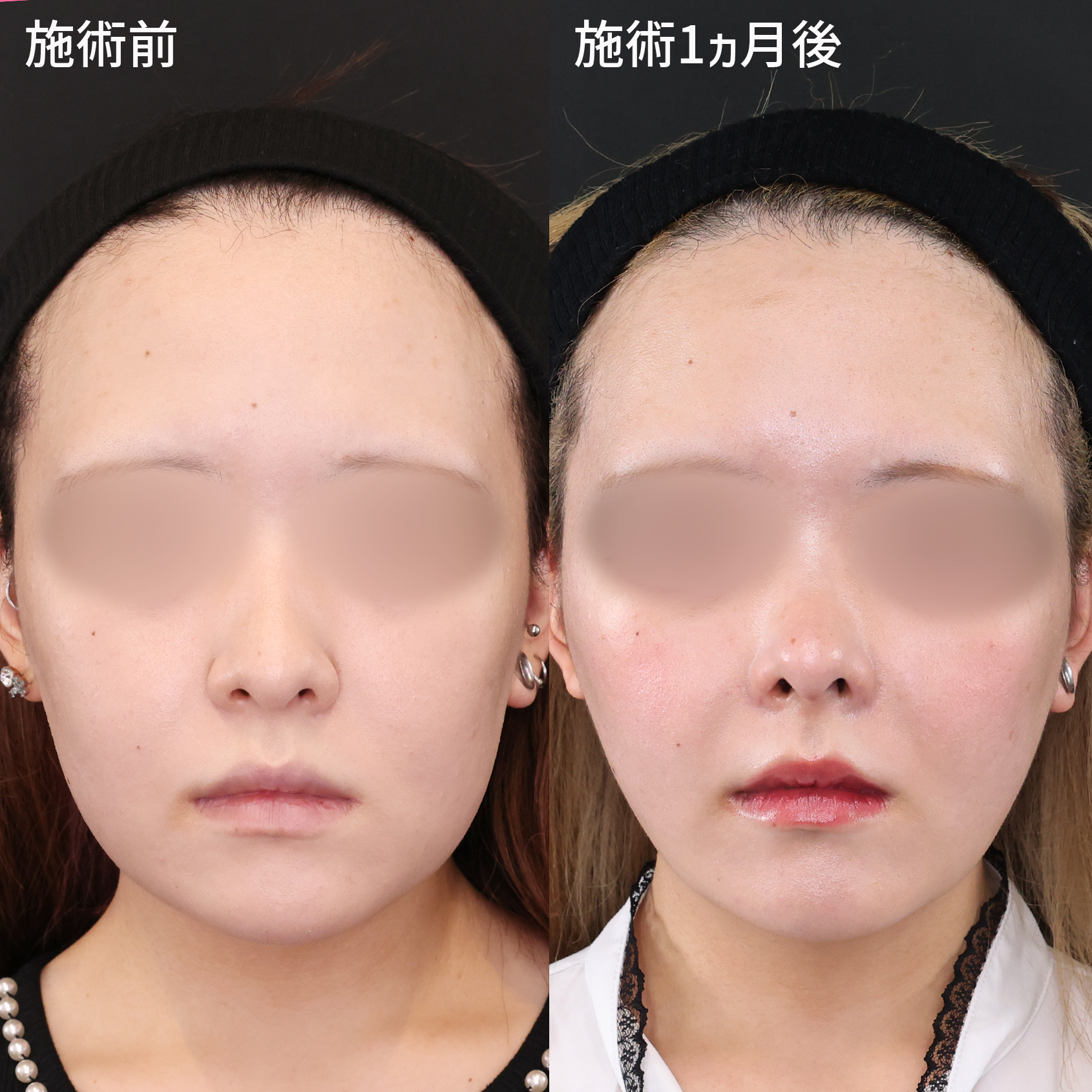 貴族手術（鼻翼基部プロテーゼ・脂肪注入・粉砕肋軟骨移植）/鼻中隔延長術/鼻尖形成・鼻尖縮小の症例写真 施術前後 