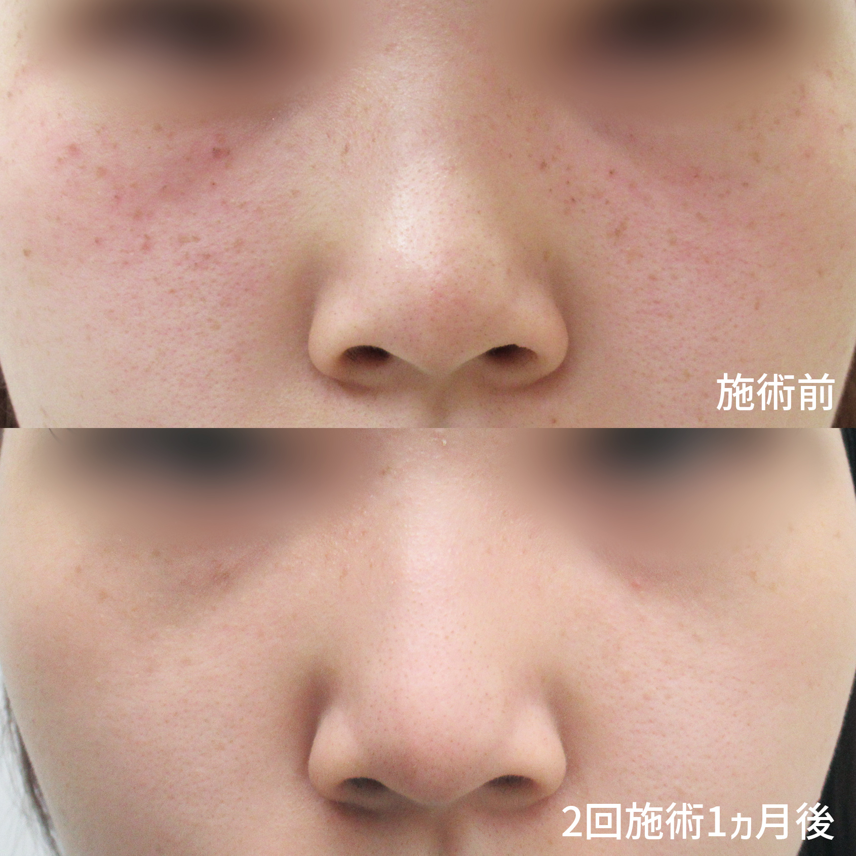 フォトシルクプラス光治療の症例写真 施術前後 
