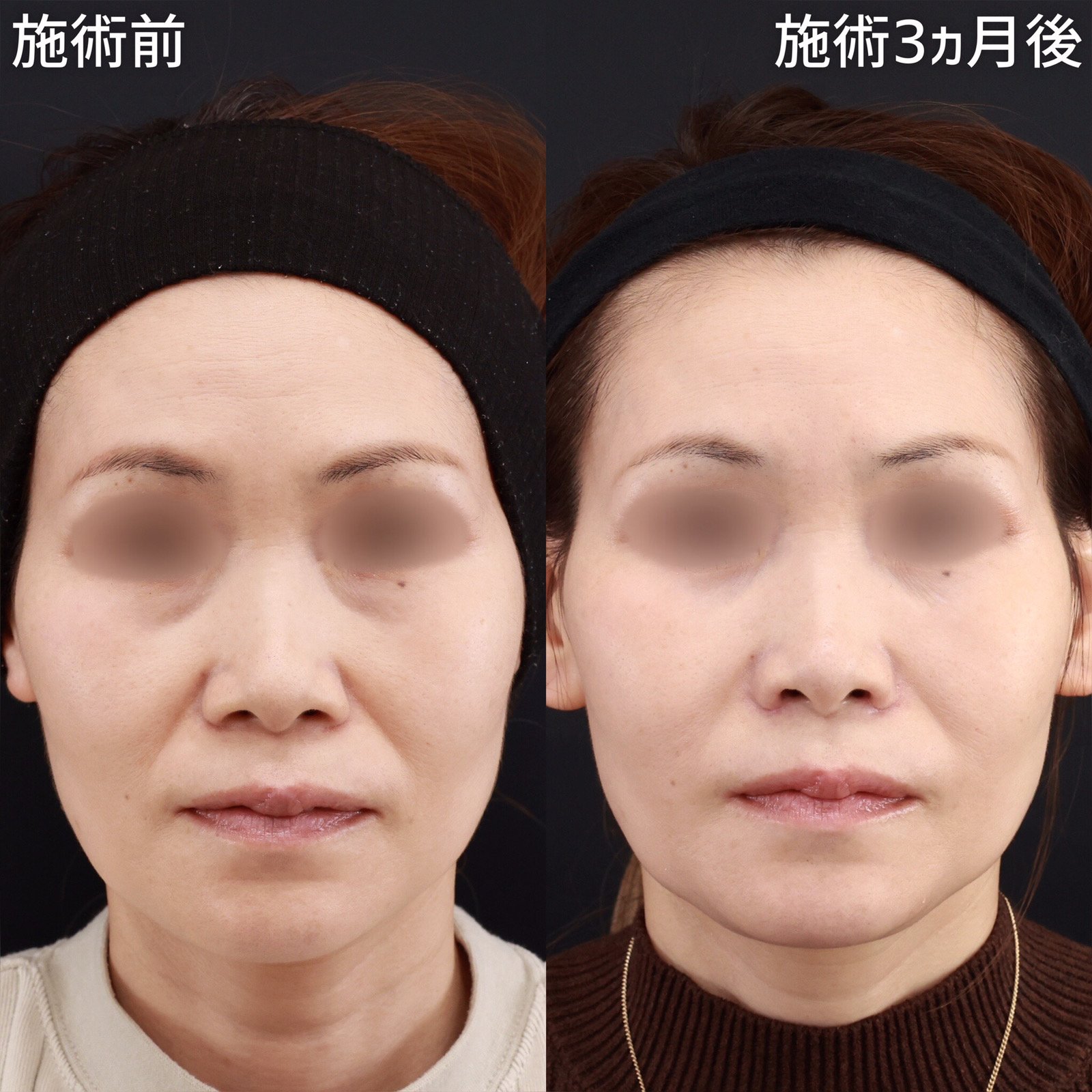 TAC式 鼻翼縮小術（小鼻縮小）/鼻孔縁挙上術/顔の脂肪注入(コンデンスリッチフェイス)の症例写真 施術前後 