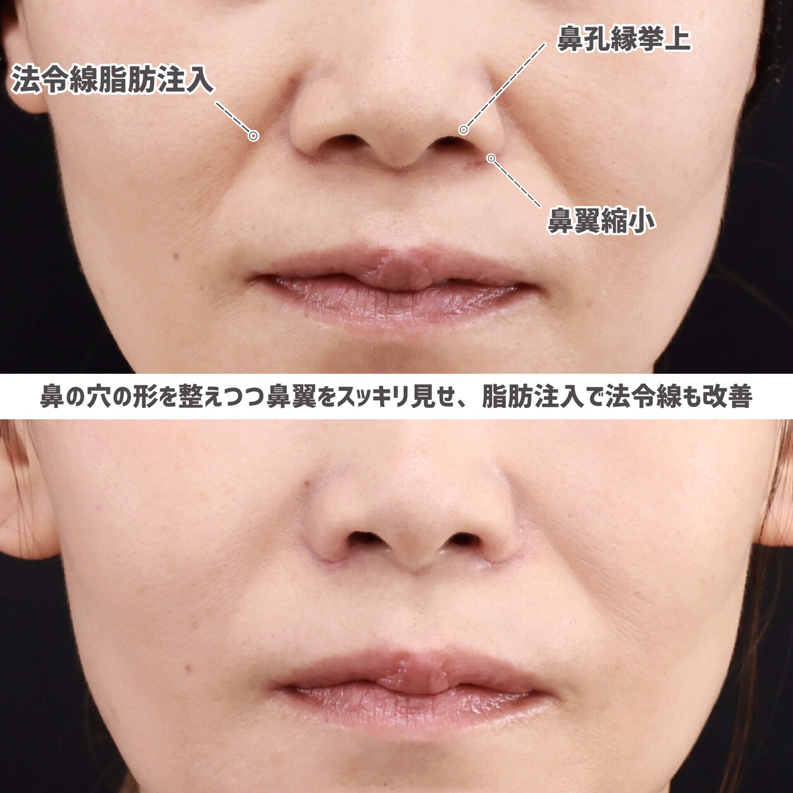 TAC式 鼻翼縮小術（小鼻縮小）/鼻孔縁挙上術/顔の脂肪注入(コンデンスリッチフェイス)の症例写真 施術前後 