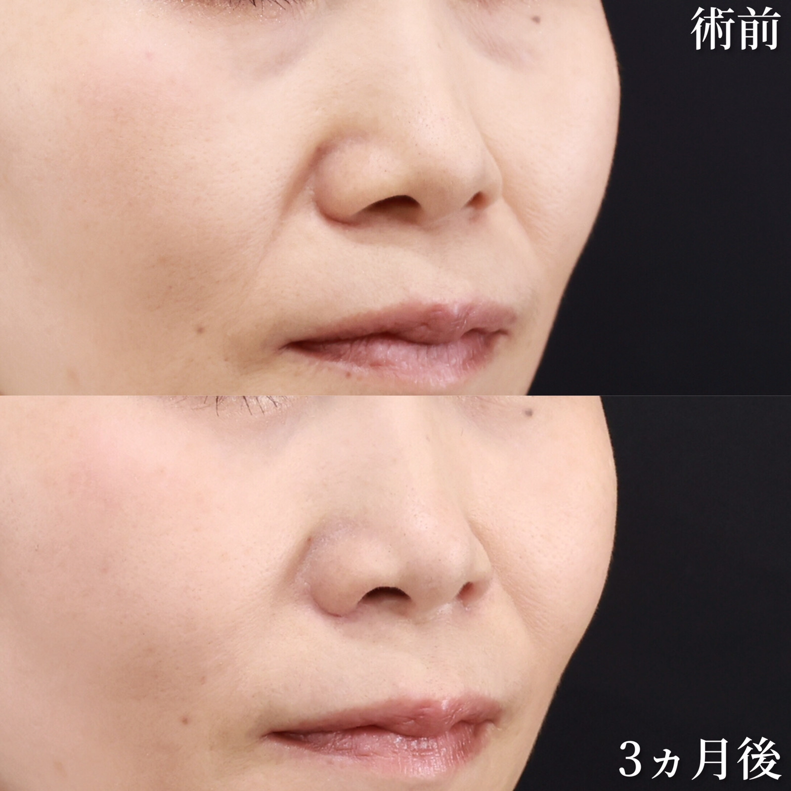 TAC式 鼻翼縮小術（小鼻縮小）/鼻孔縁挙上術/顔の脂肪注入(コンデンスリッチフェイス)の症例写真 施術前後 