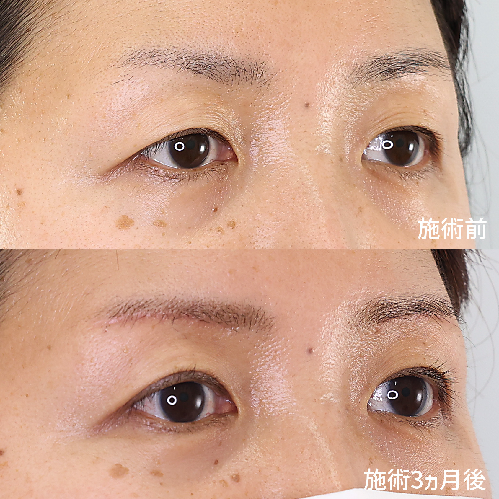 眉毛下切開術の症例写真 施術前後 
