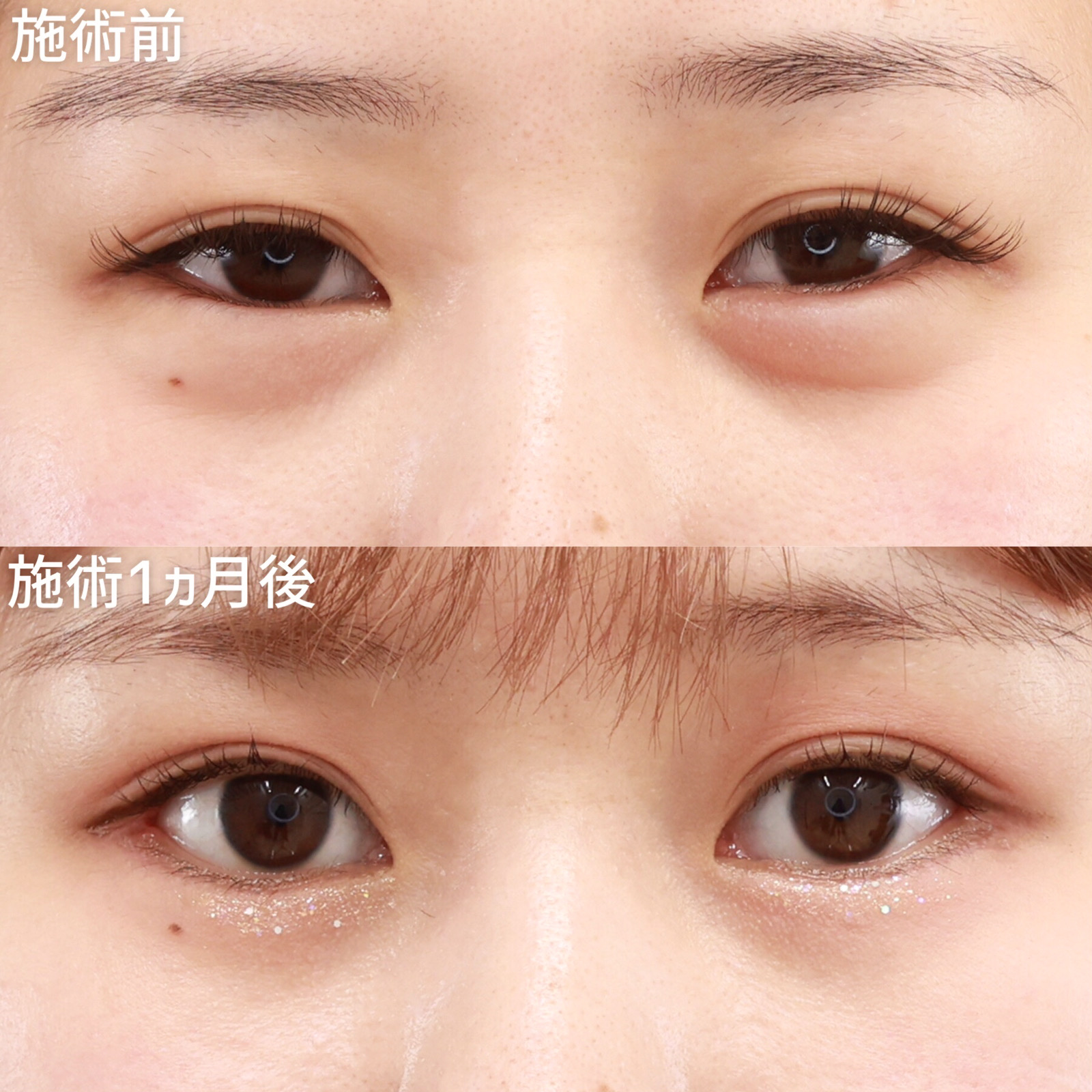 グラマラスライン（タレ目形成）/目尻切開術の症例写真 施術前後 