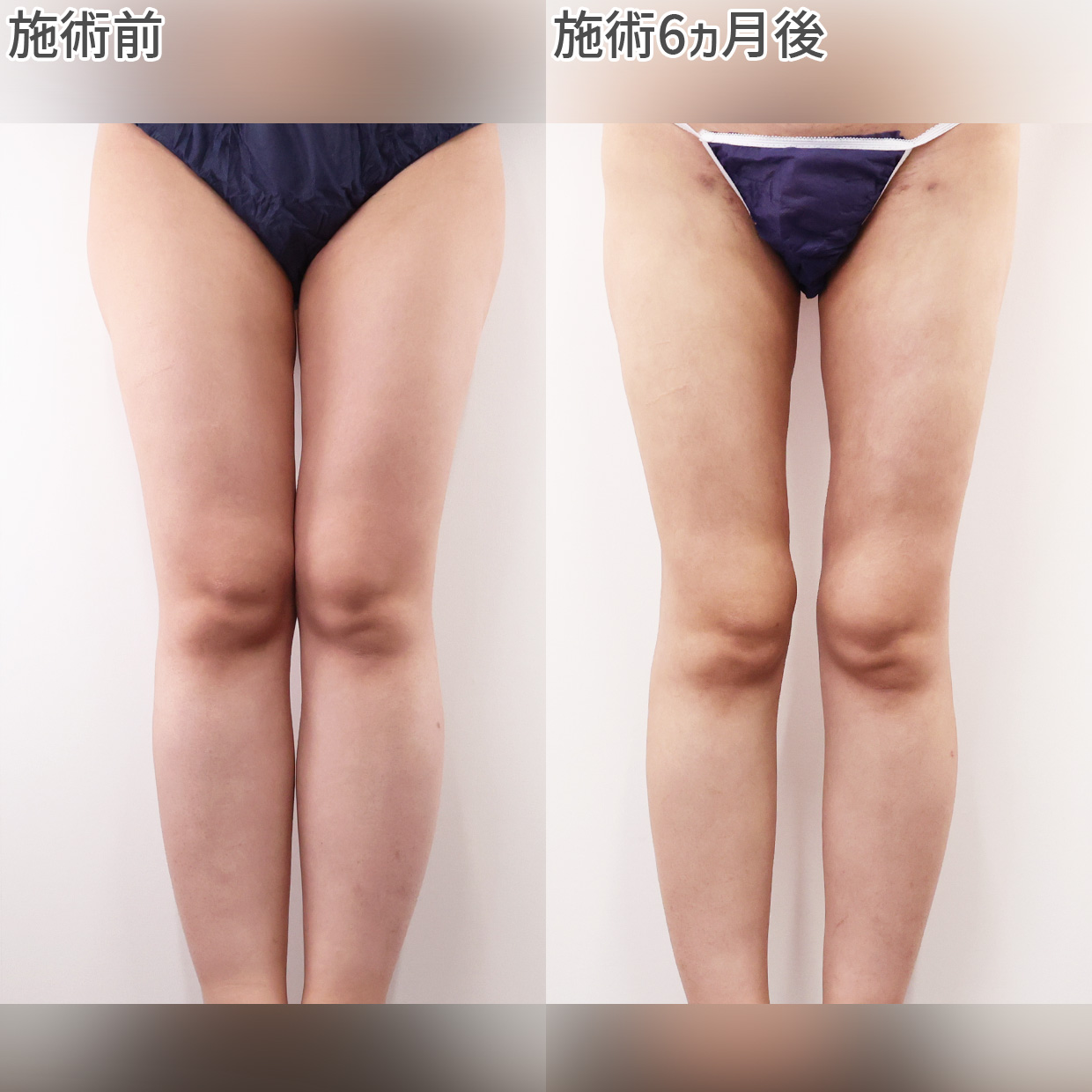 体の脂肪吸引の症例写真 施術前後 