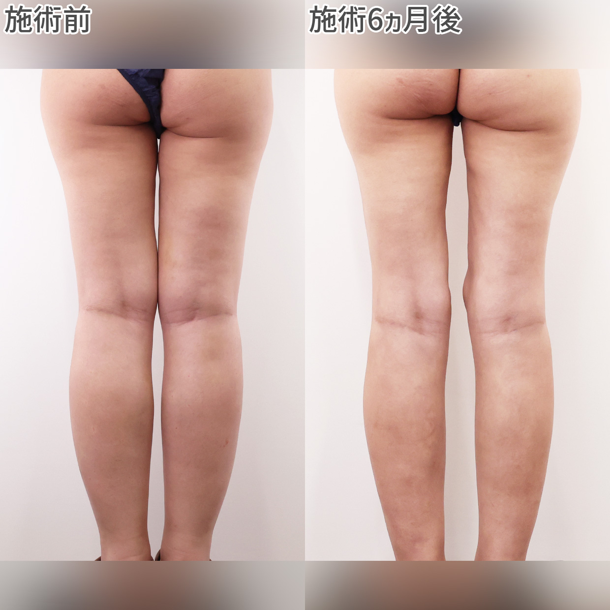 体の脂肪吸引の症例写真 施術前後 