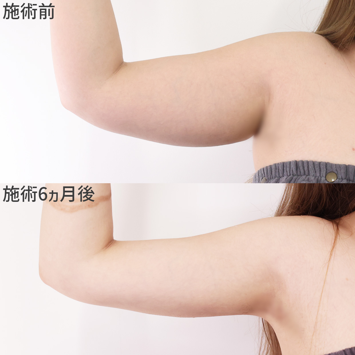 体の脂肪吸引の症例写真 施術前後 