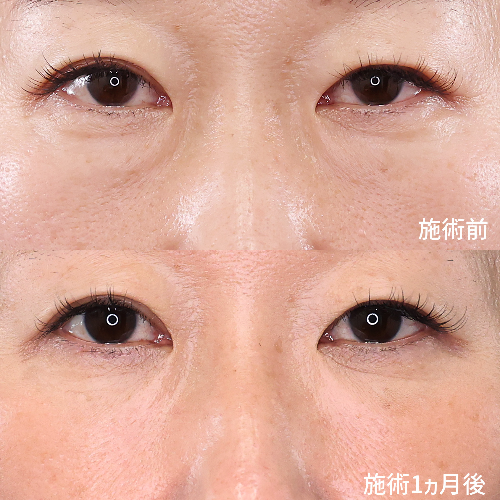 下眼瞼脱脂術（目の下のたるみ取り・目の下の脂肪ふくらみ取り）の症例写真 施術前後 