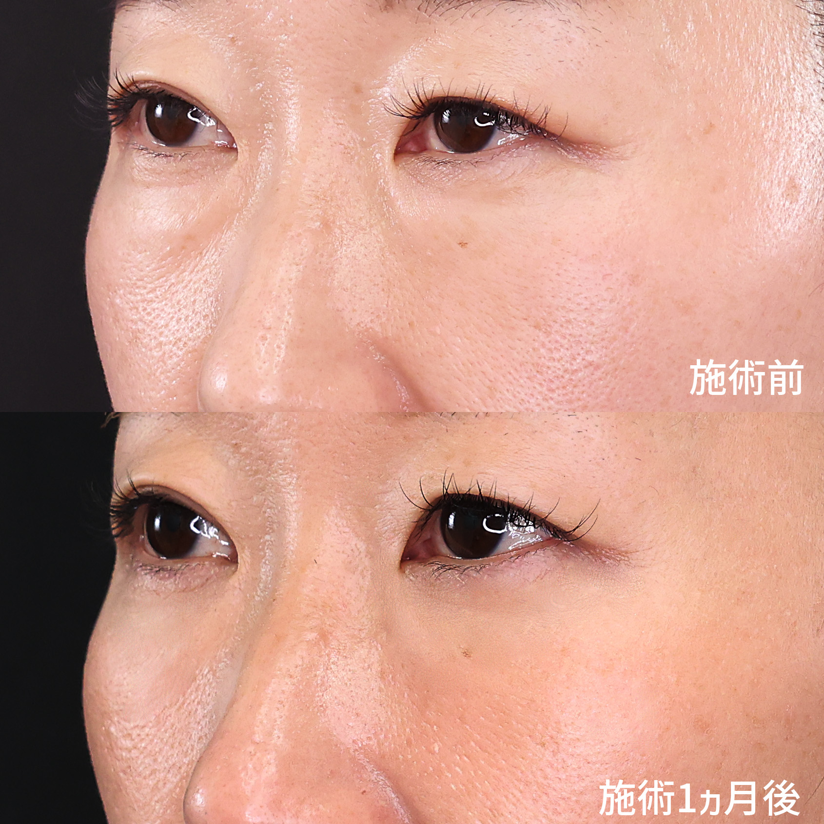 下眼瞼脱脂術（目の下のたるみ取り・目の下の脂肪ふくらみ取り）の症例写真 施術前後 