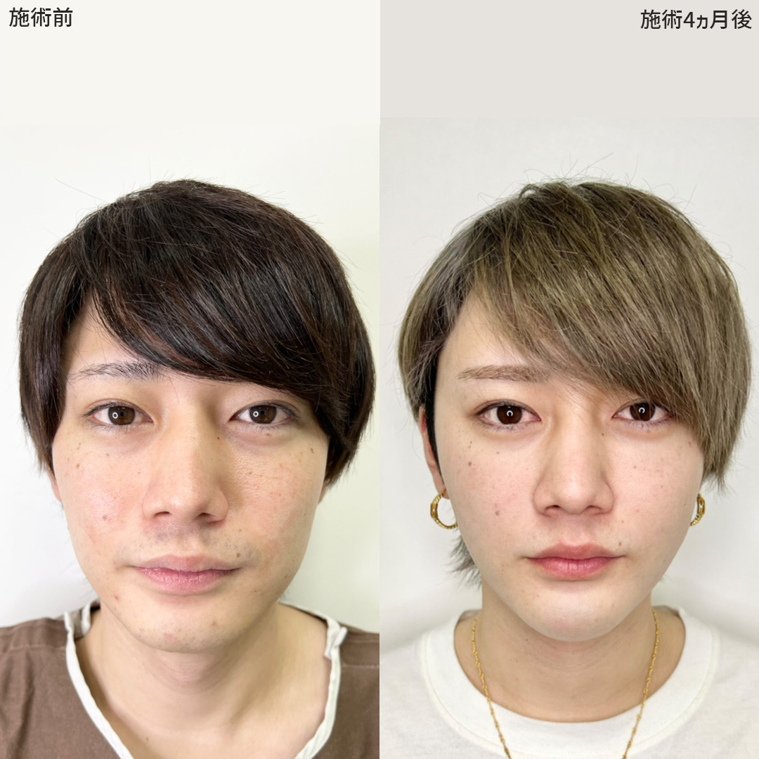 TAC式 ツヤ肌コラーゲンリフト®/顎下の脂肪吸引/下眼瞼脱脂術（目の下のたるみ取り・目の下の脂肪ふくらみ取り）の症例写真 施術前後 