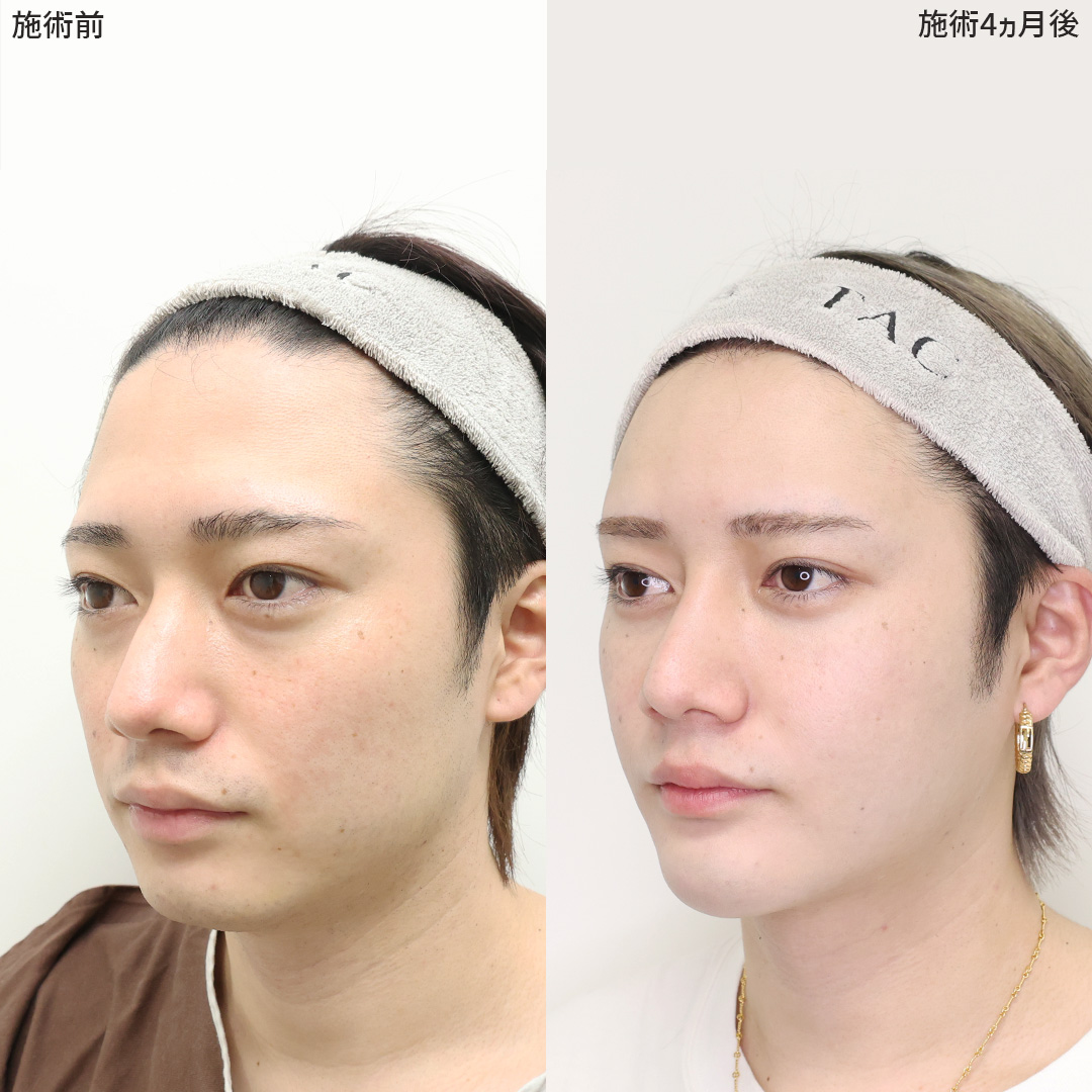 TAC式 ツヤ肌コラーゲンリフト®/顎下の脂肪吸引/下眼瞼脱脂術（目の下のたるみ取り・目の下の脂肪ふくらみ取り）の症例写真 施術前後 