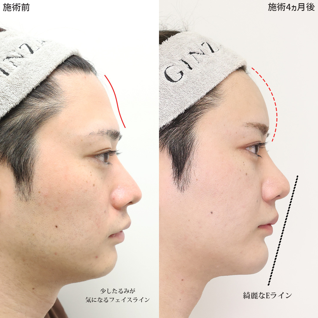 TAC式 ツヤ肌コラーゲンリフト®/顎下の脂肪吸引/下眼瞼脱脂術（目の下のたるみ取り・目の下の脂肪ふくらみ取り）の症例写真 施術前後 