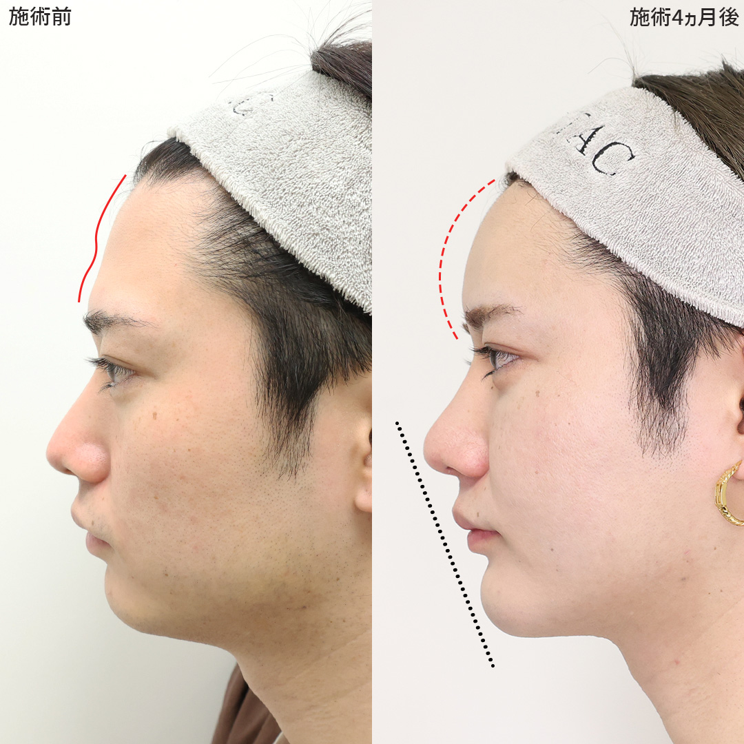 TAC式 ツヤ肌コラーゲンリフト®/顎下の脂肪吸引/下眼瞼脱脂術（目の下のたるみ取り・目の下の脂肪ふくらみ取り）の症例写真 施術前後 
