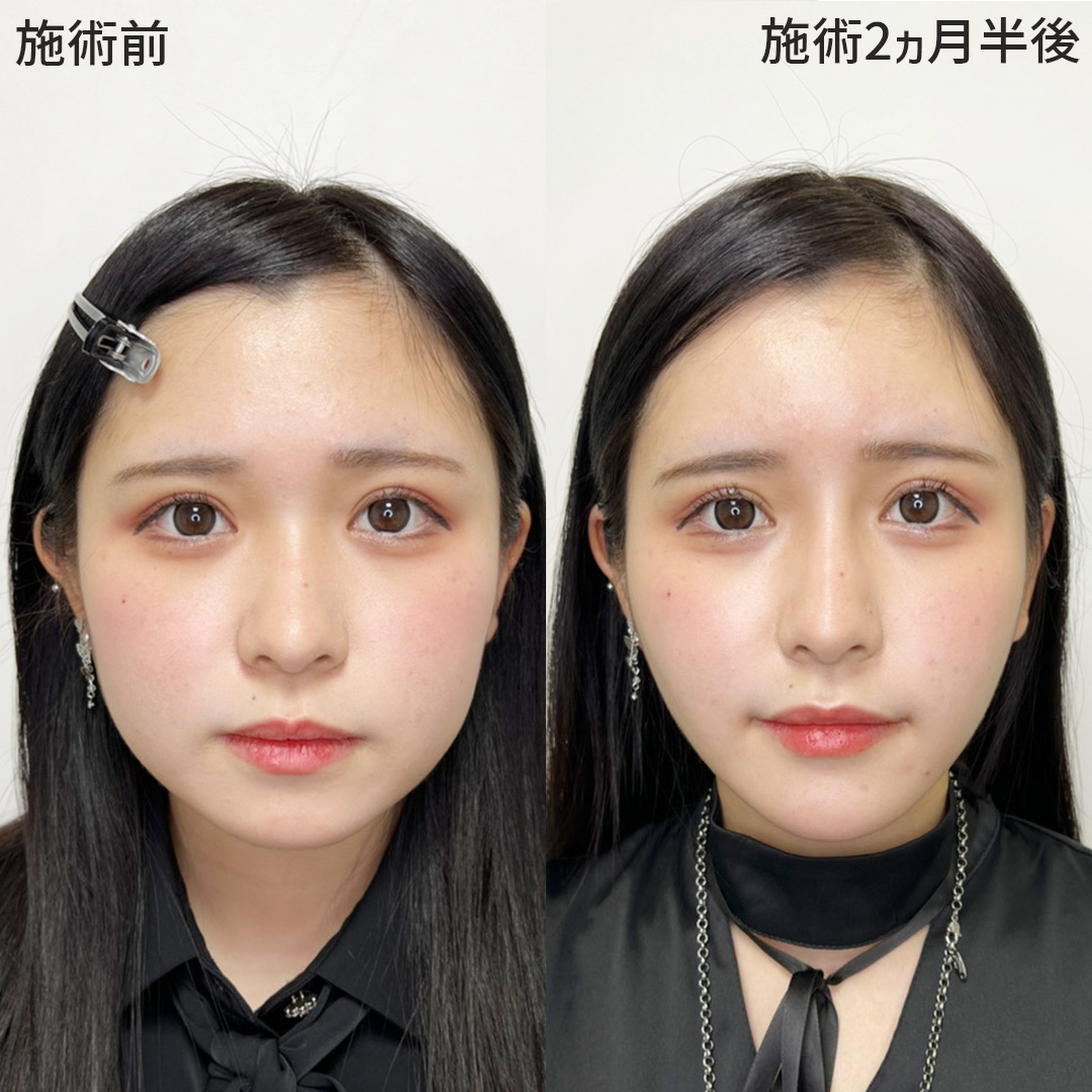 TAC式 ツヤ肌コラーゲンリフト®/バッカルファット除去/ジョールファット除去の症例写真 施術前後 