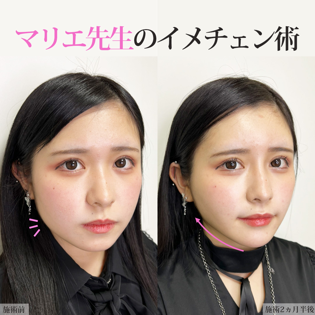 TAC式 ツヤ肌コラーゲンリフト®/バッカルファット除去/ジョールファット除去の症例写真 施術前後 