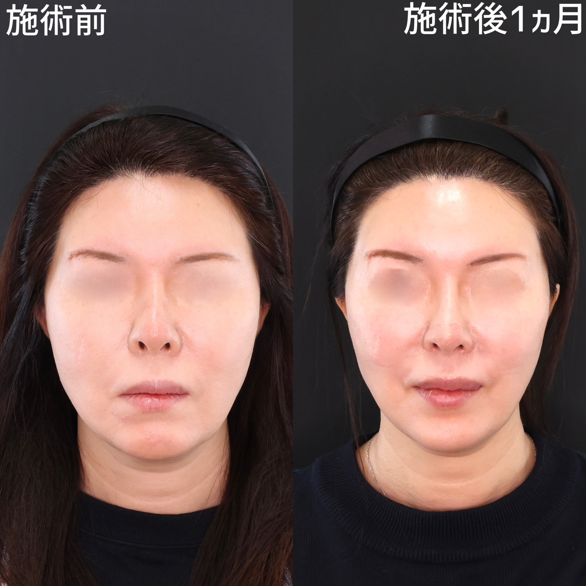 TAC式 ツヤ肌コラーゲンリフト®/ボトックス注射：その他の症例写真 施術前後 