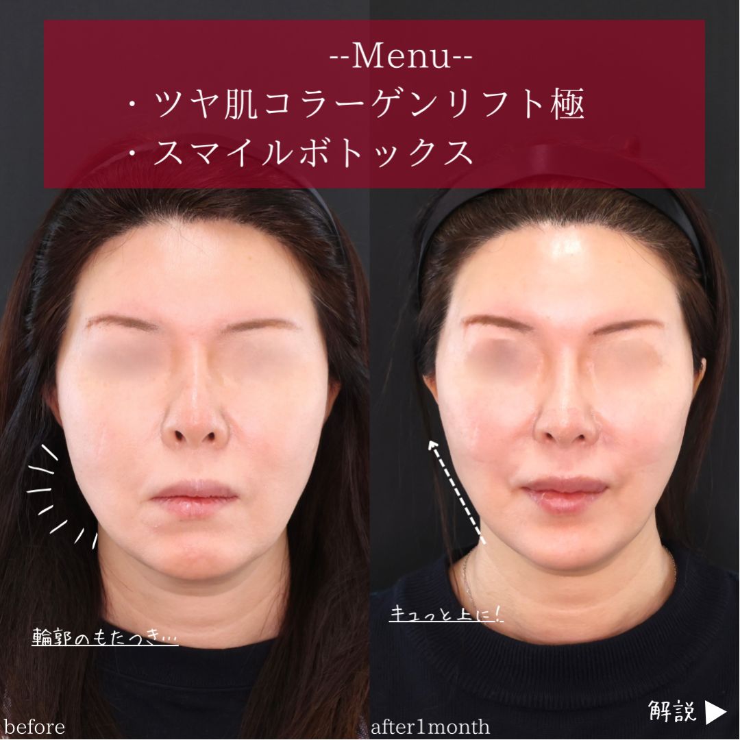 TAC式 ツヤ肌コラーゲンリフト®/ボトックス注射：その他の症例写真 施術前後 