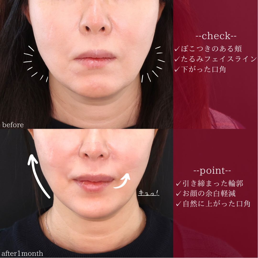 TAC式 ツヤ肌コラーゲンリフト®/ボトックス注射：その他の症例写真 施術前後 