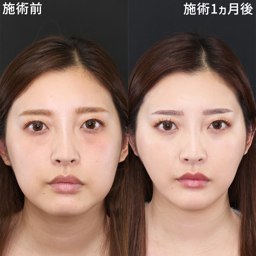 下眼瞼脱脂術（目の下のたるみ取り・目の下の脂肪ふくらみ取り）/TAC式 ツヤ肌コラーゲンリフト®/顎下の脂肪吸引の症例写真 施術前後 