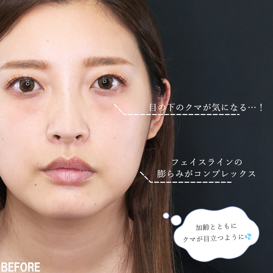 下眼瞼脱脂術（目の下のたるみ取り・目の下の脂肪ふくらみ取り）/TAC式 ツヤ肌コラーゲンリフト®/顎下の脂肪吸引の症例写真 施術前後 