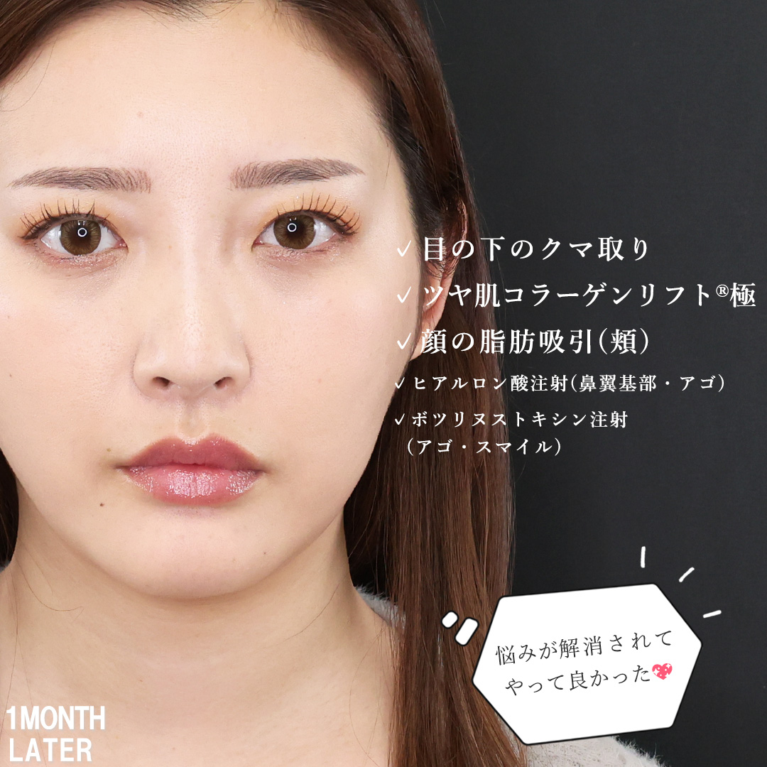 下眼瞼脱脂術（目の下のたるみ取り・目の下の脂肪ふくらみ取り）/TAC式 ツヤ肌コラーゲンリフト®/顎下の脂肪吸引の症例写真 施術前後 