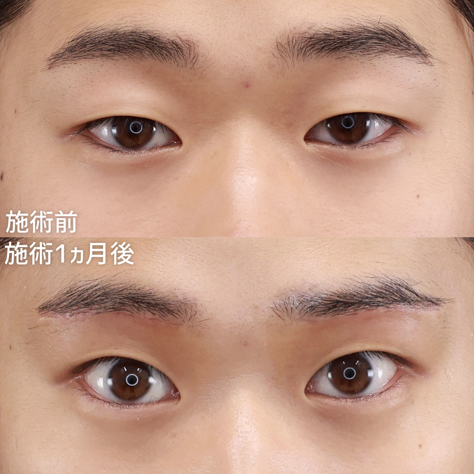 眉毛下切開術の症例写真 施術前後 