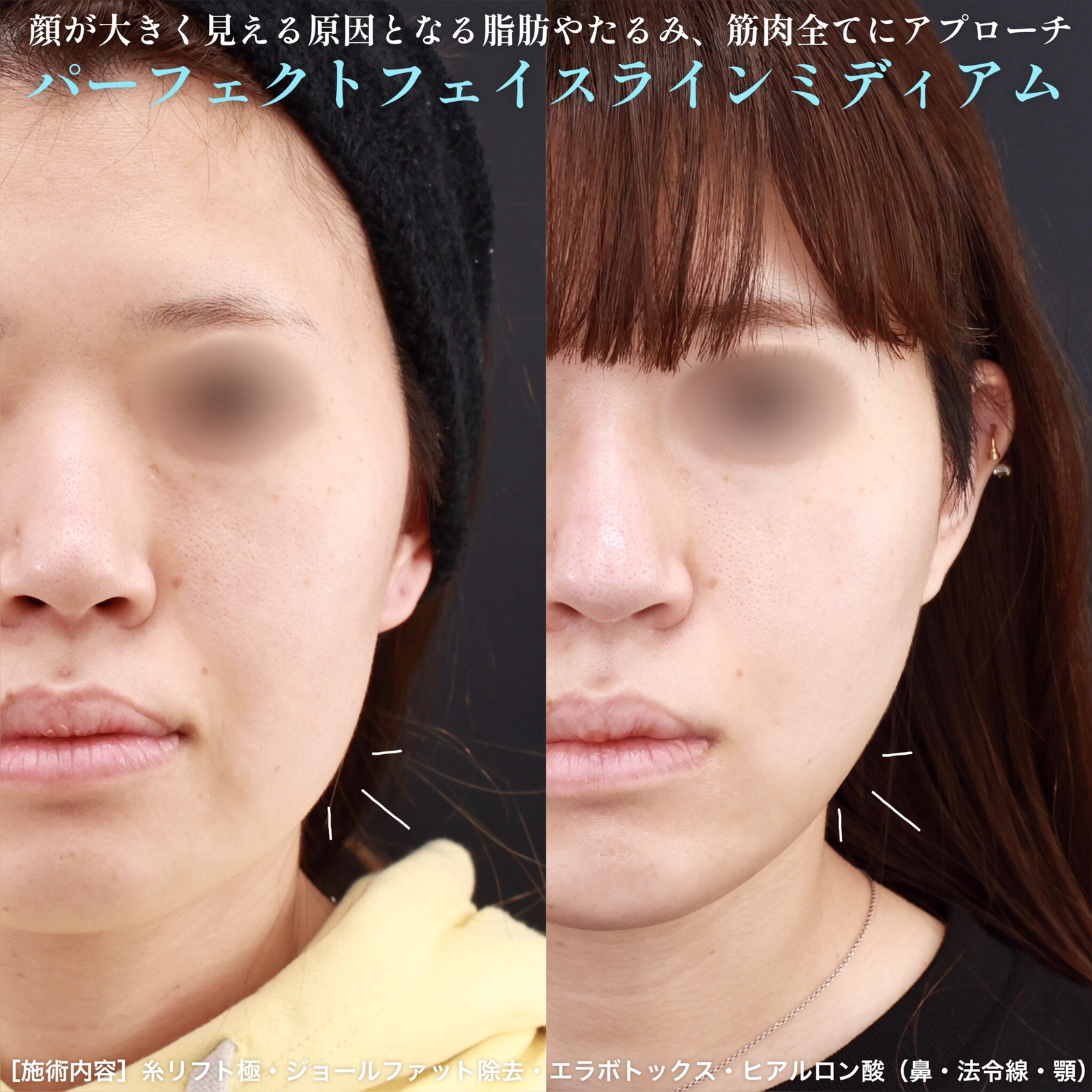 小顔整形｜パーフェクトフェイスライン/ジョールファット除去/TAC式 ツヤ肌コラーゲンリフト®の症例写真 施術前後 