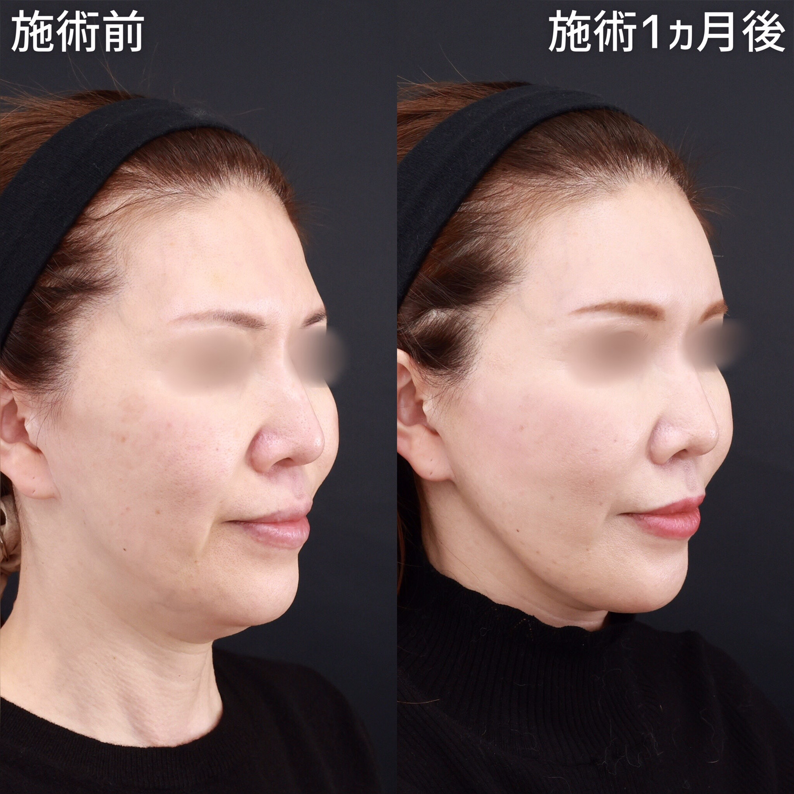 TAC式 ツヤ肌コラーゲンリフト®/顎下の脂肪吸引/顔の脂肪注入(コンデンスリッチフェイス)の症例写真 施術前後 