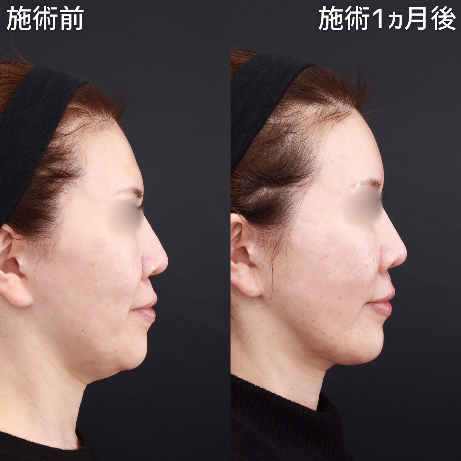 TAC式 ツヤ肌コラーゲンリフト®/顎下の脂肪吸引/顔の脂肪注入(コンデンスリッチフェイス)の症例写真 施術前後 