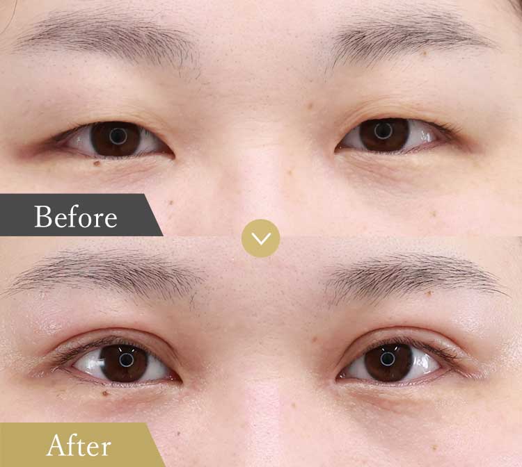 二重全切開＋眼瞼下垂＋目頭切開の複合施術の症例写真