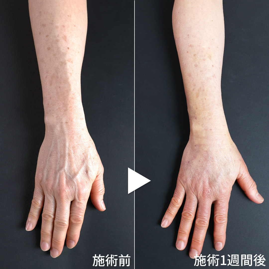 ハンドベイン（手のアンチエイジング・血管治療）の症例写真 施術前後 